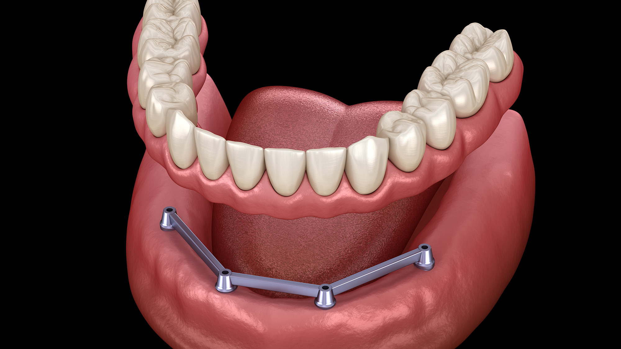 Bar Supported Implant Dentures 